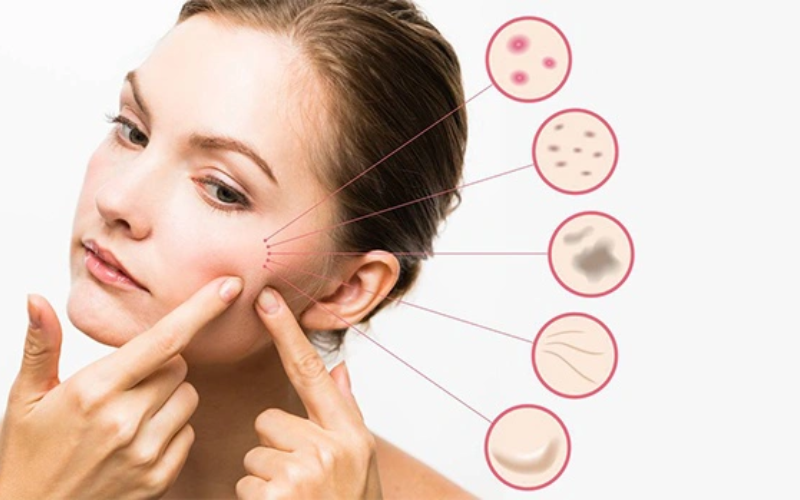 Acid azelaic kết hợp với sản phẩm dưỡng da nào tốt?