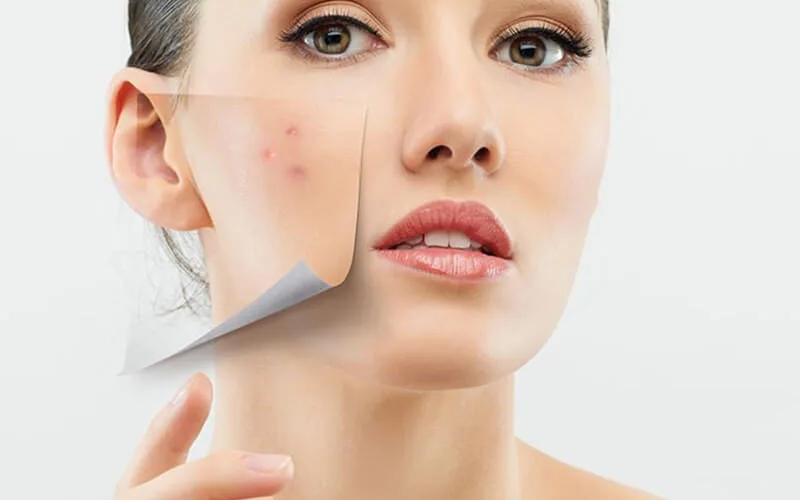 Azelaic Acid - Mandelic Acid: So sánh hiệu quả trị mụn và sáng da