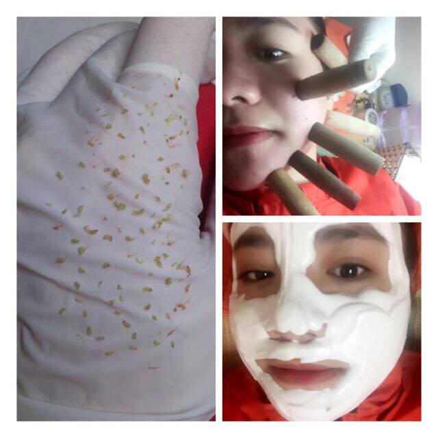 nặn mụn lăn ống tre tại spa Bích Lê House Hà Nội