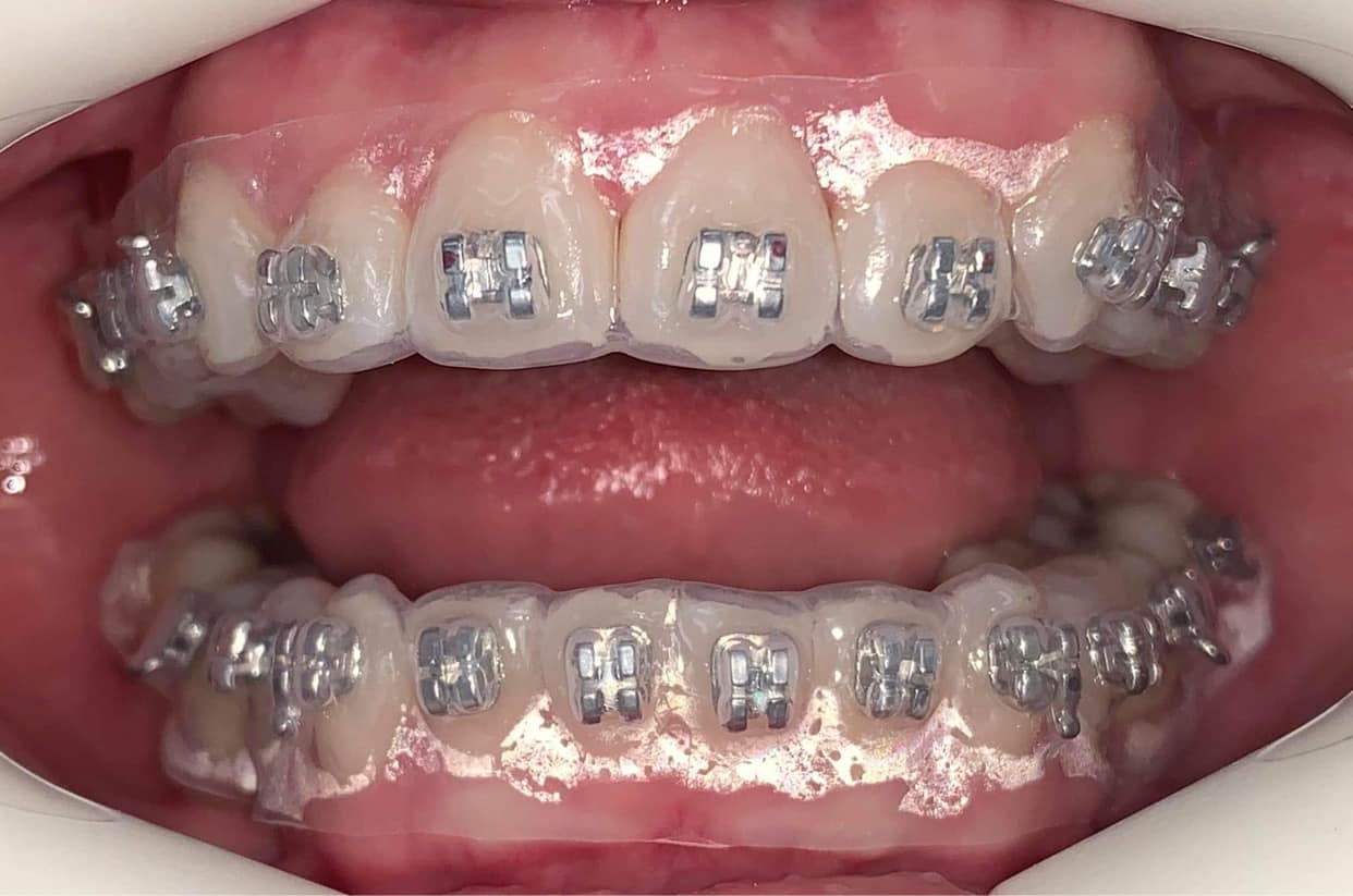 GẮN MẮC CÀI GIÁN TIẾP: TẠI SAO KHÔNG?