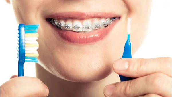 Hướng dẫn vệ sinh răng miệng khi đang niềng răng