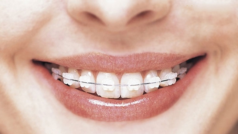 Niềng răng trở thành xu hướng làm đẹp an toàn và hiệu quả