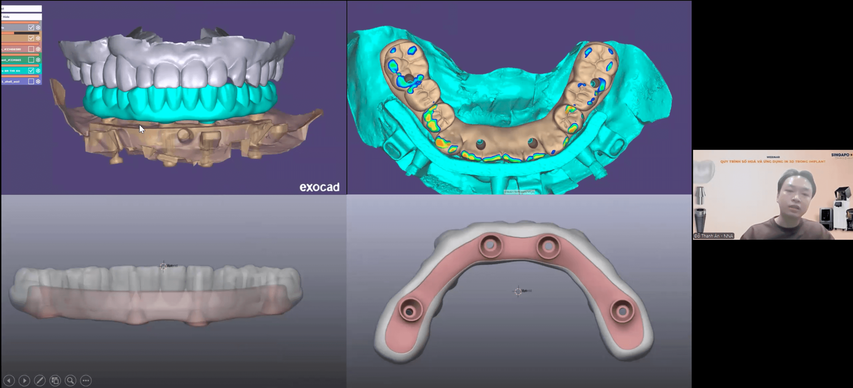 [WEBINAR RECAP] – CẬP NHẬT XU HƯỚNG CẤY GHÉP IMPLANT SỐ HÓA CÙNG THS.BS. ĐỖ THANH ÂN