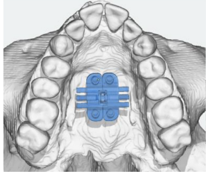 Ứng dụng lâm sàng và kết quả điều trị của MARPE kỹ thuật số trong chỉnh nha: Tổng quan luận điểm