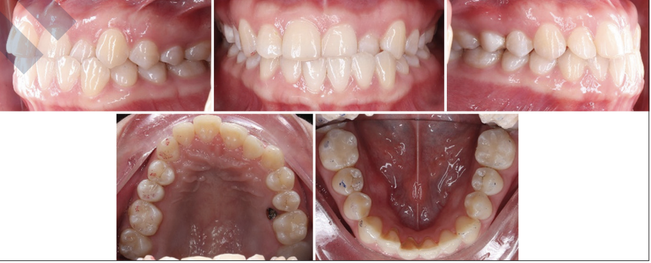 ĐIỀU TRỊ CHỈNH NHA TĂNG TỐC VÀ KẾT HỢP SỬ DỤNG NIỀNG RĂNG MẶT LƯỠI VÀ KHAY IN TRỰC TIẾP TẠI PHÒNG KHÁM: BÁO CÁO CA LÂM SÀNG CẮN CHÉO RĂNG TRƯỚC VÀ RỐI LOẠN KHỚP THÁI DƯƠNG HÀM SAU 1 NĂM THEO DÕI