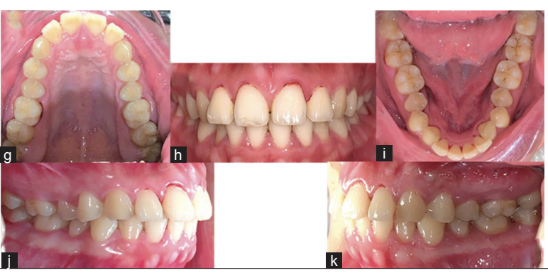 Buccal corridor and gummy smile treatment with MARPE and gingivoplasty: A 2-year follow-up case report
