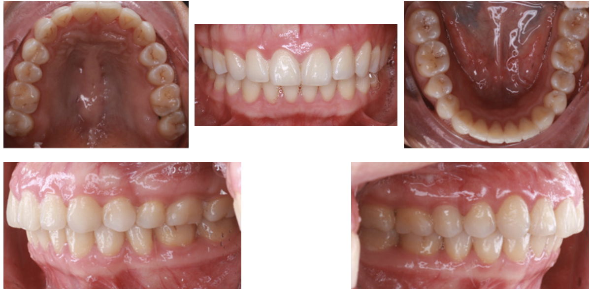 Improvements of facial profile and smile aesthetic using temporary anchorage devices and botulinum toxin: a case report
