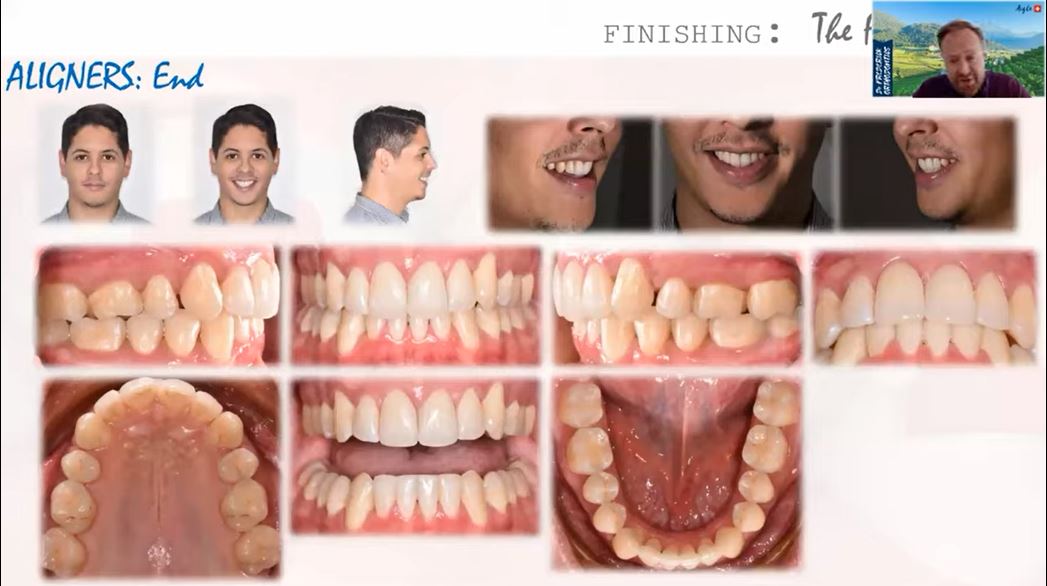 Tinh chỉnh với máng trong suốt - Dr Frederick Berardinelli (Host by Dr Simple)