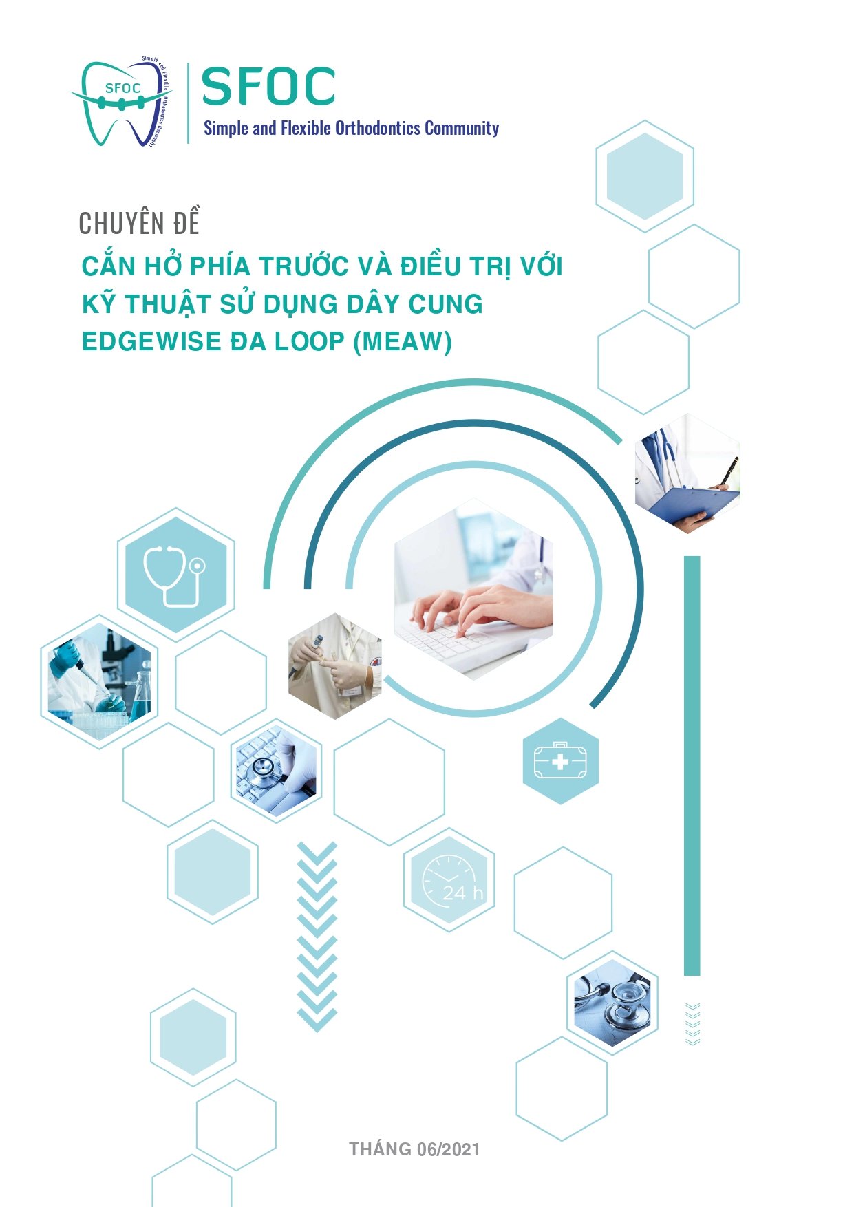 Cắn hở phía trước và điều trị với kỹ thuật sử dụng dây cung Edgewise đa loop (Meaw)