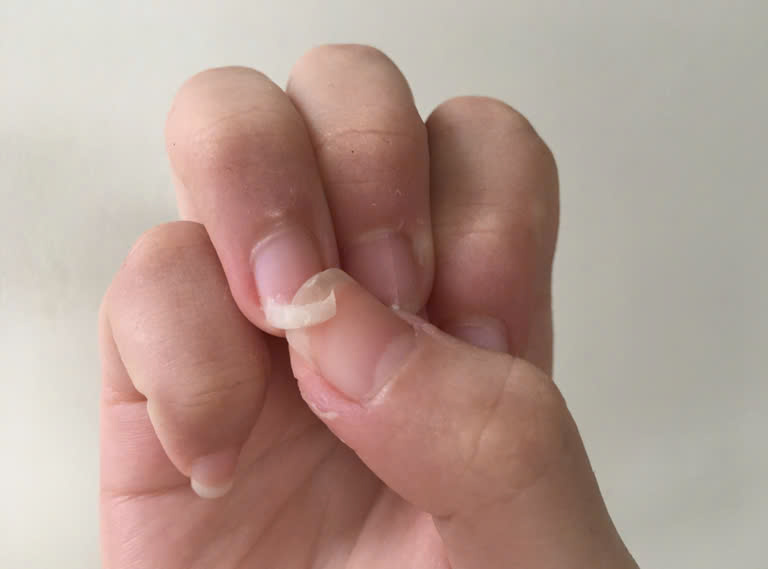 6 thay đổi ở móng tay do thiếu vitamin