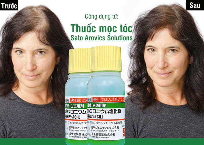 TINH CHẤT BÔI KÍCH THÍCH MỌC TÓC SATO AROVIC SOLUTIONS 5% THẢO DƯỢC 30ML |  NHÀ THUỐC PHÚC AN