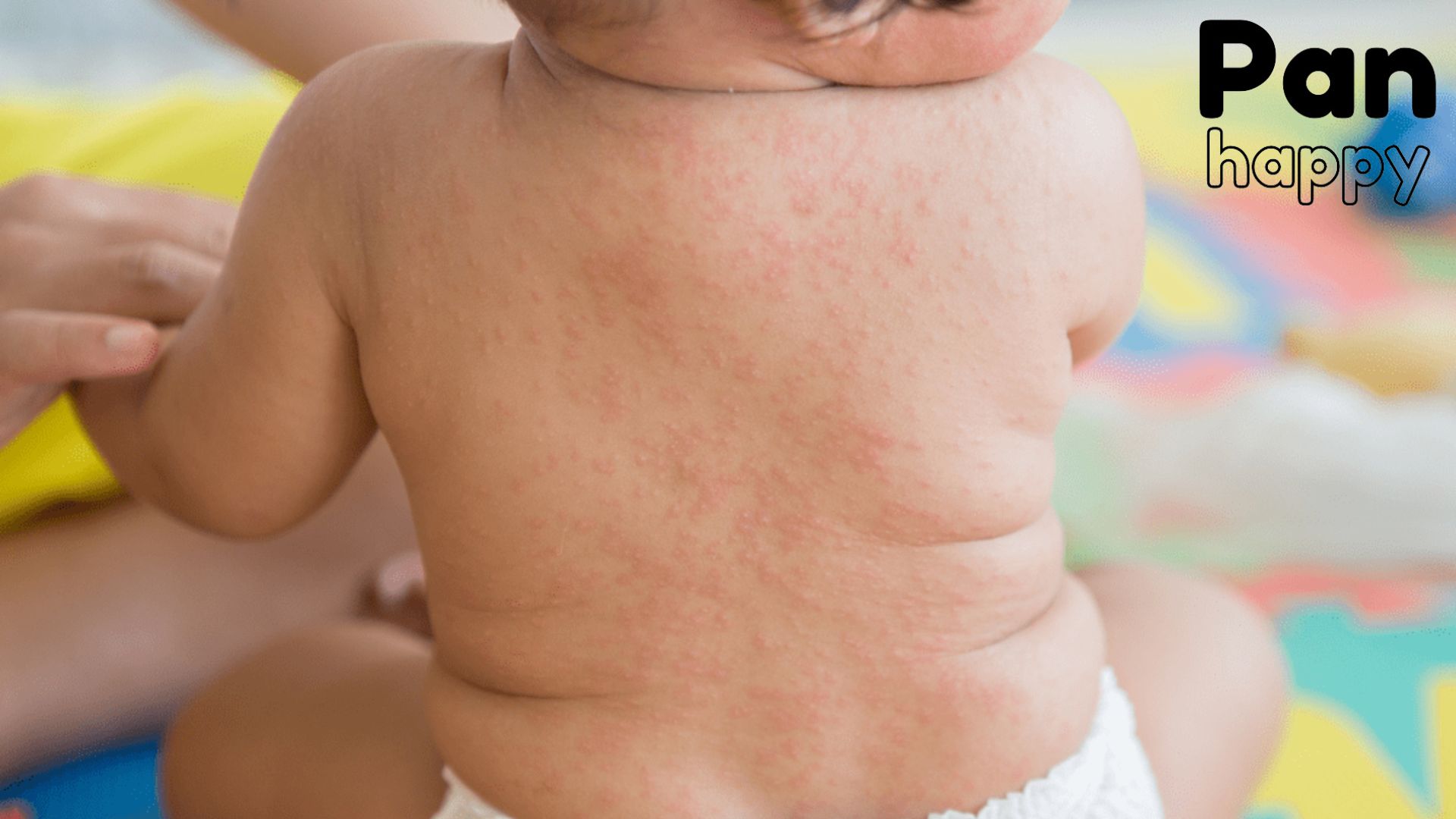 Bệnh xuất huyết giảm tiểu cầu miễn dịch ở trẻ em
