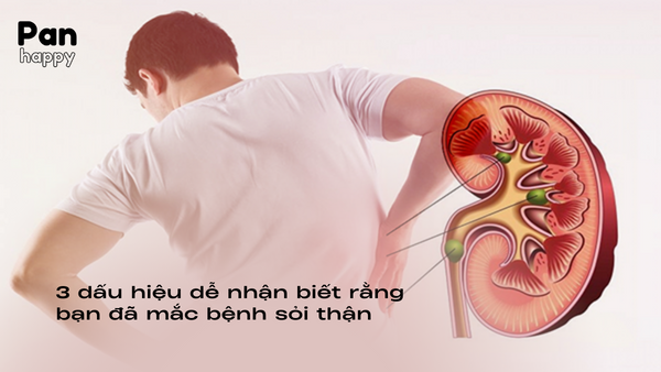 3 dấu hiệu dễ nhận biết rằng bạn đã mắc bệnh sỏi thận