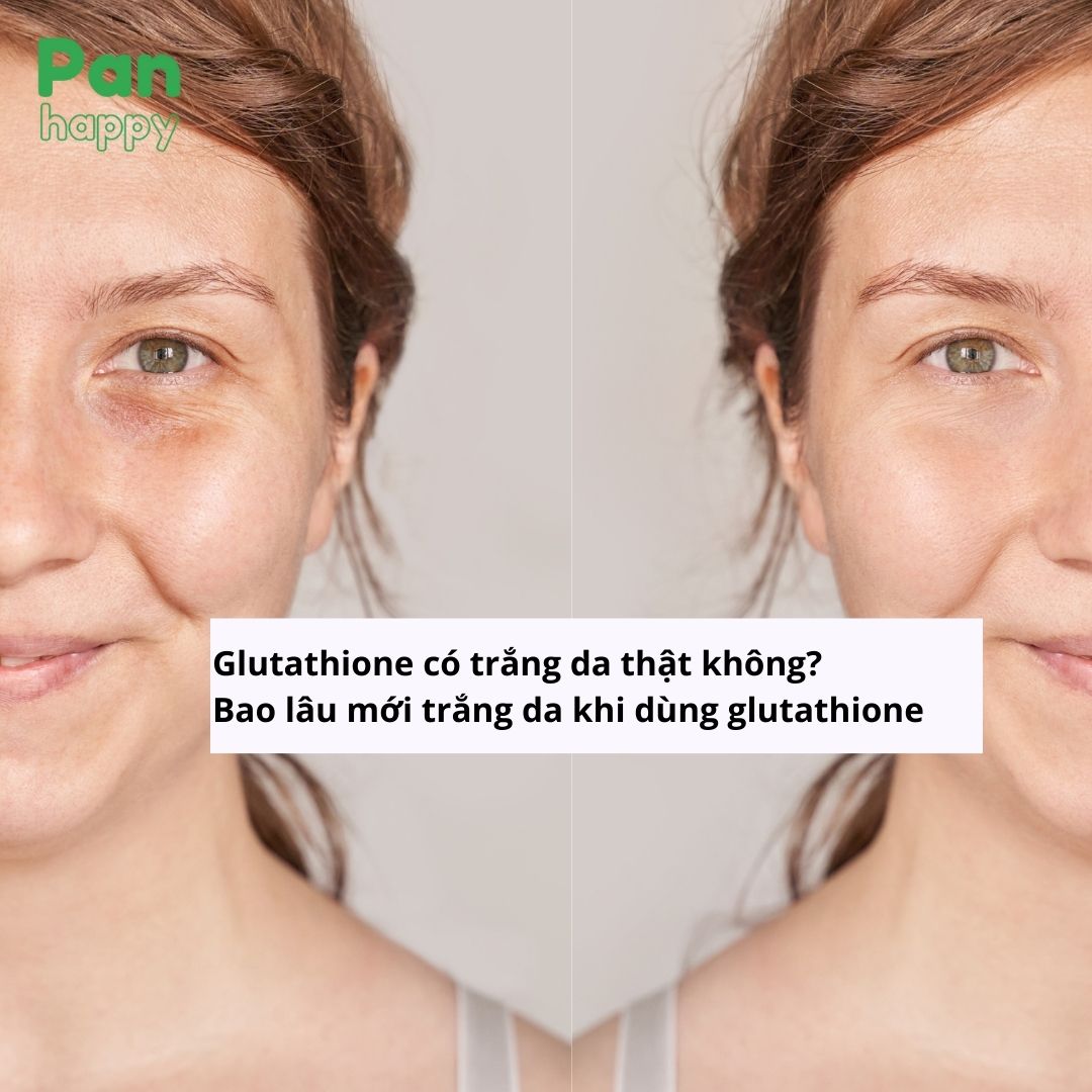 Glutathione có trắng da thật không? Làm thế nào trắng da, giảm hắc sắc tố