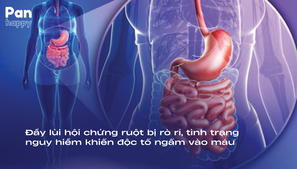 Đẩy lùi ruột bị rò rỉ, tình trạng nguy hiểm khiến độc tố ngấm vào máu