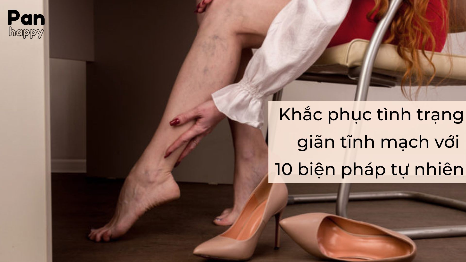 Khắc phục tình trạng giãn tĩnh mạch với 10 biện pháp tự nhiên