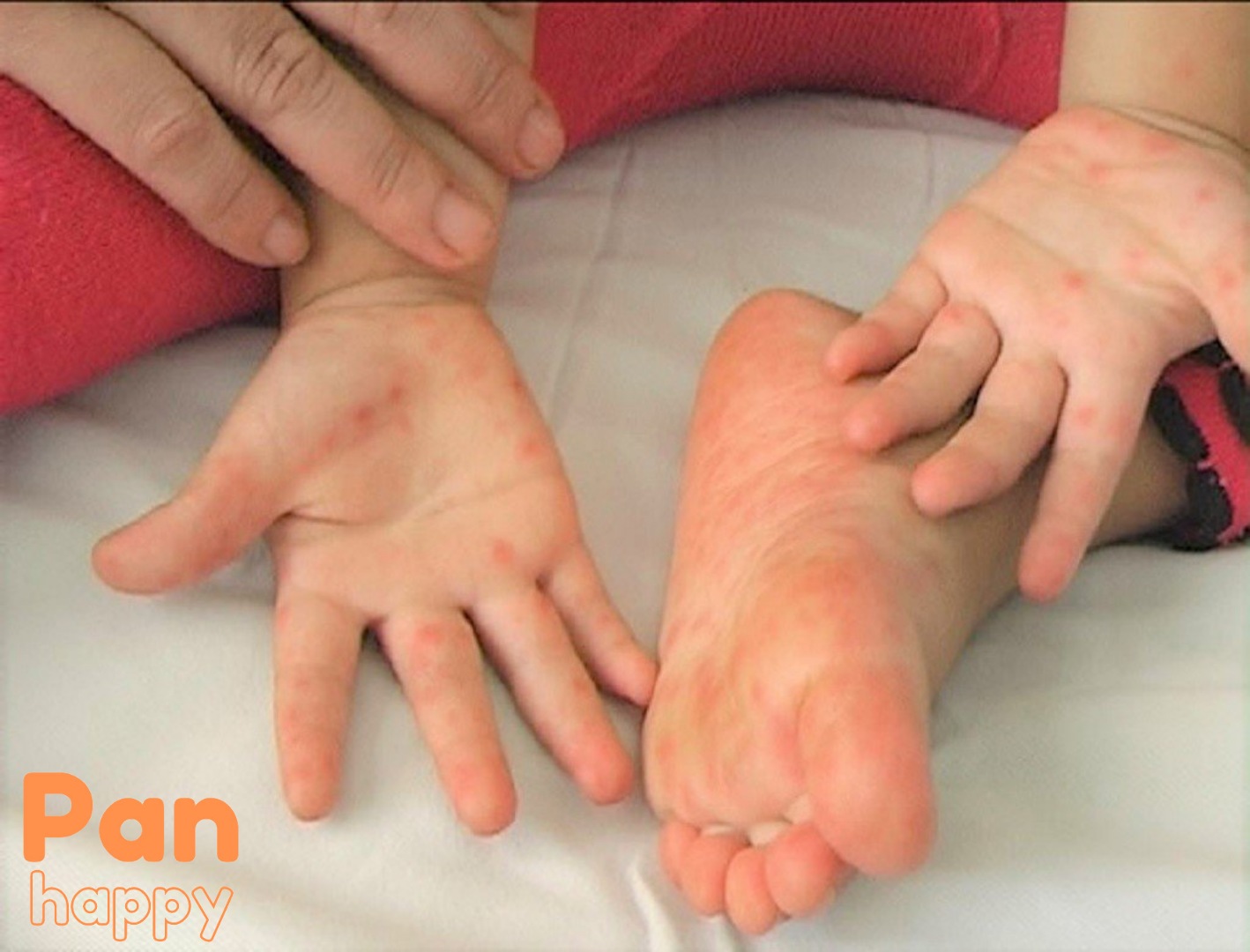 Bệnh tay chân miệng ở trẻ em: Chẩn đoán, điều trị và cách phòng bệnh
