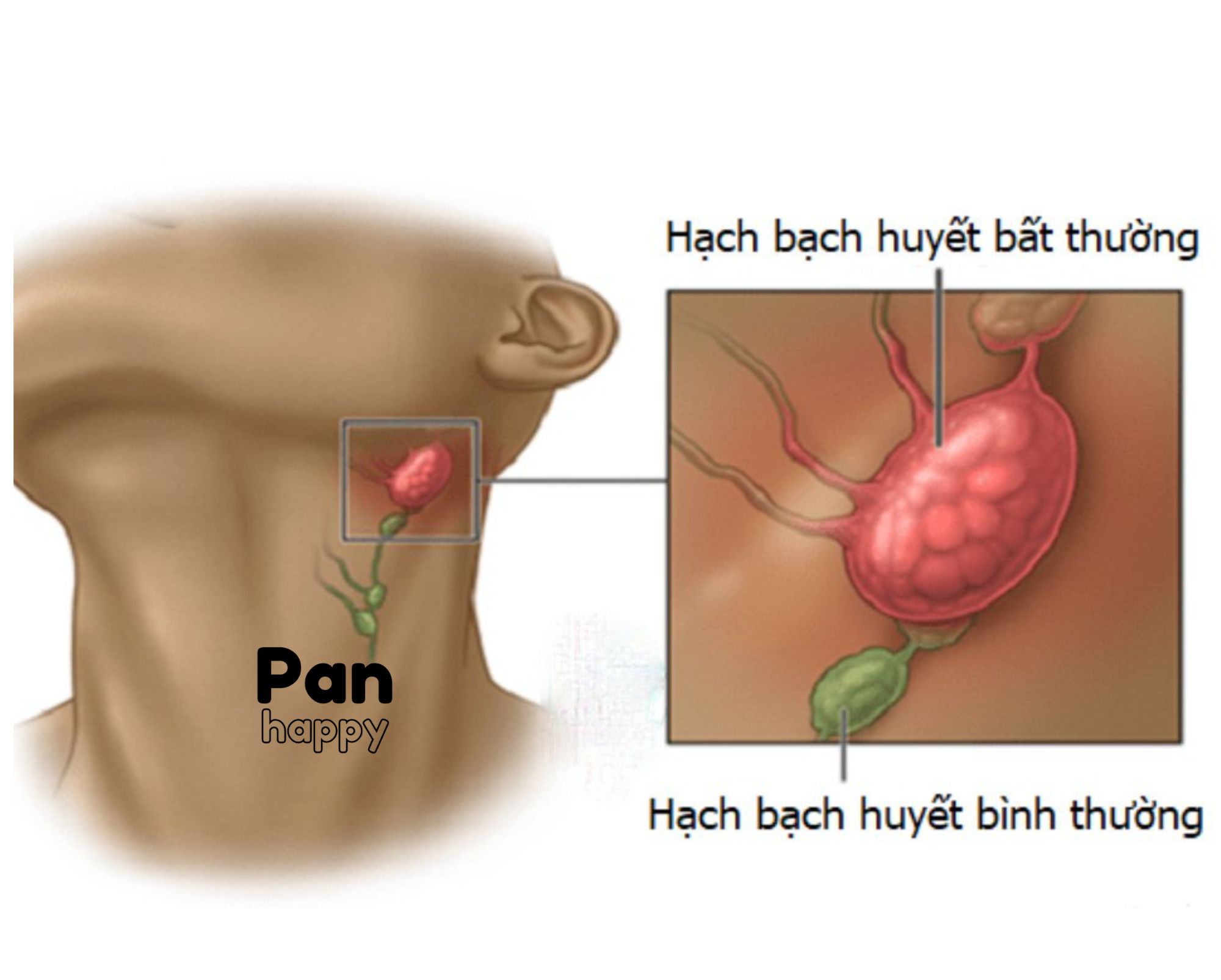 Bệnh nhân ung thư hạch bạch huyết được tiếp thêm hy vọng với phương pháp điều trị mới