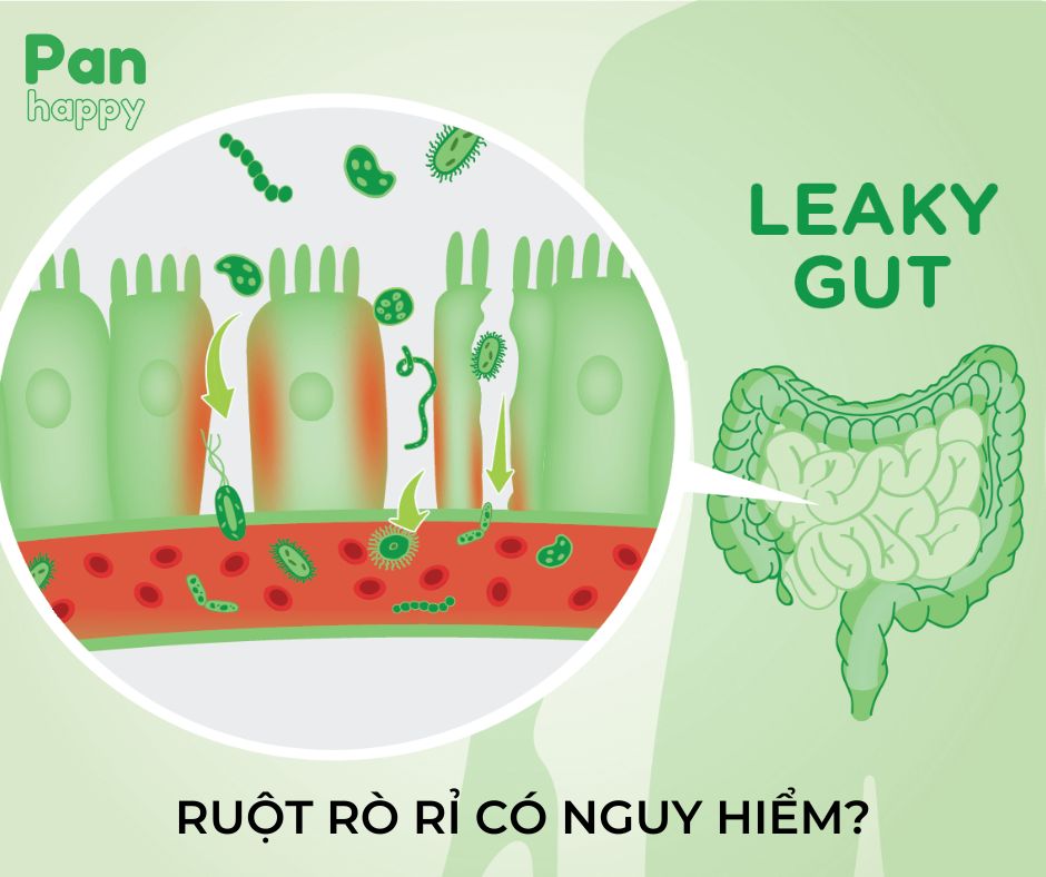 Ruột rò rỉ có nguy hiểm không? Triệu chứng và cách chữa trị