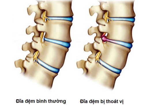 Phương pháp cải thiện tận gốc thoát vị đĩa đệm tại nhà