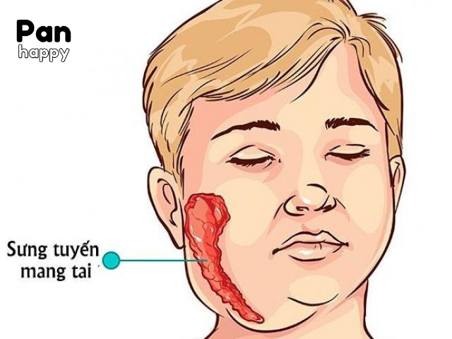 Bệnh quai bị: căn bệnh nguy hiểm ở nam giới