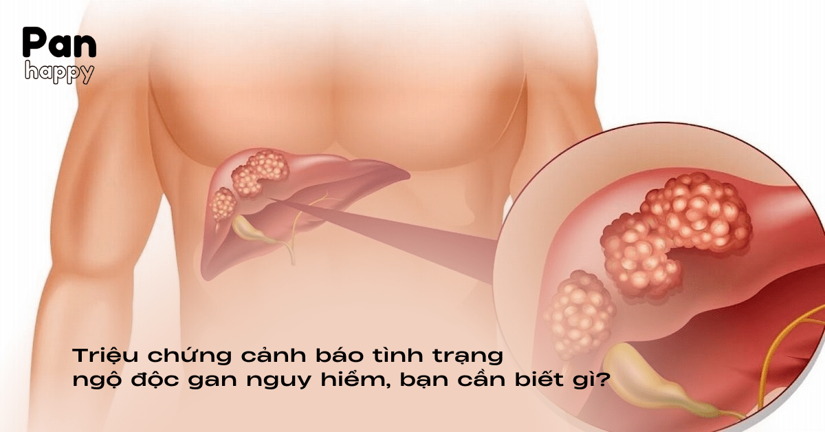 Triệu chứng gây ra tình trạng ngộ độc gan nguy hiểm, bạn cần biết gì?