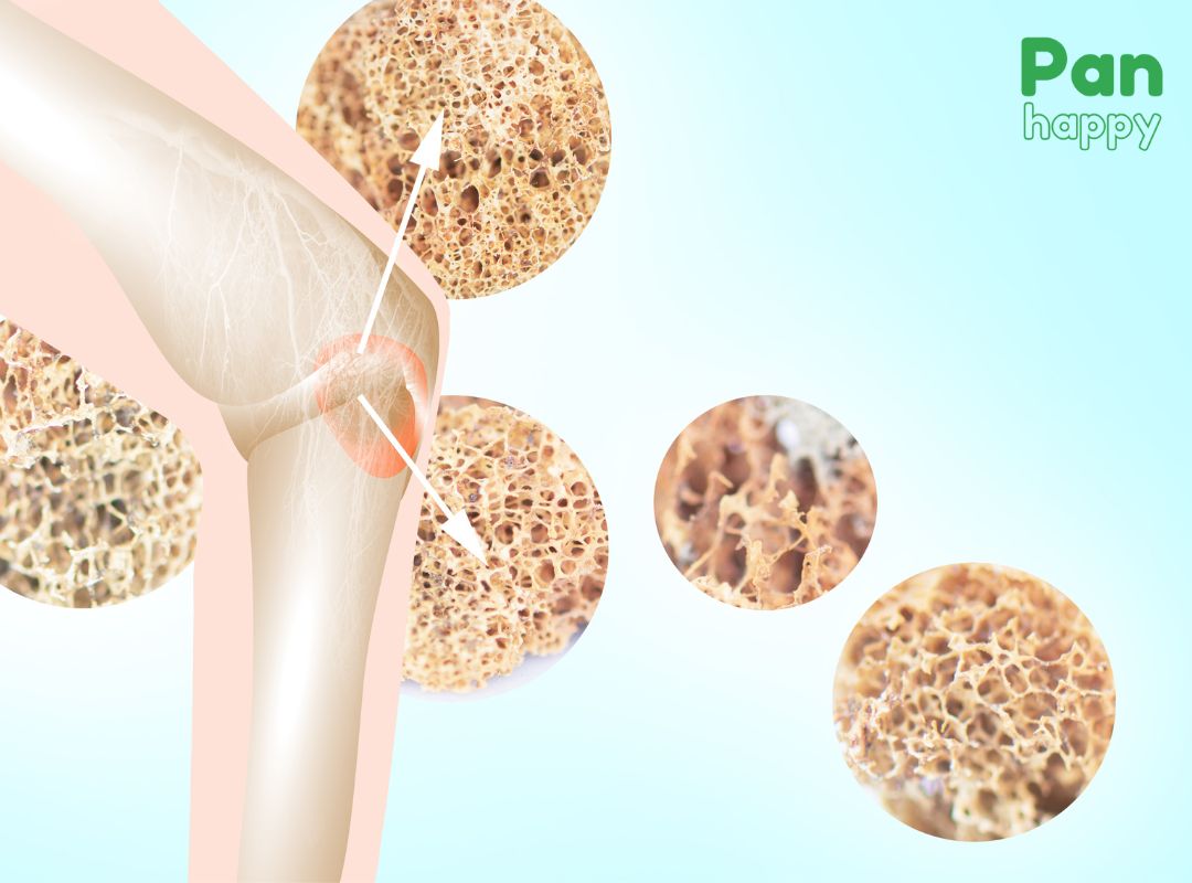 Thiếu Vitamin D tăng nguy cơ loãng xương