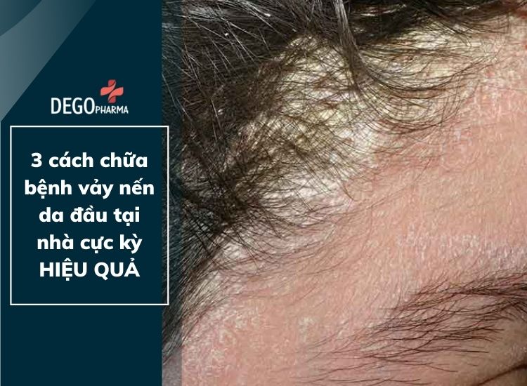 Bật mí 3 cách chữa bệnh vảy nến da đầu tại nhà cực kỳ HIỆU QUẢ