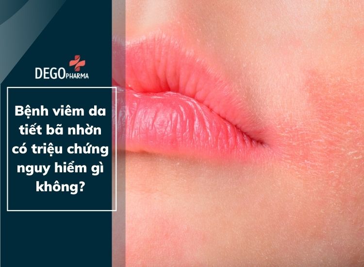 Bệnh viêm da tiết bã nhờn có triệu chứng nguy hiểm gì không?