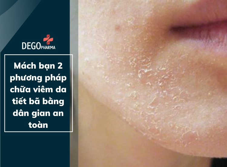 Mách bạn 2 phương pháp chữa viêm da tiết bã bằng dân gian an toàn