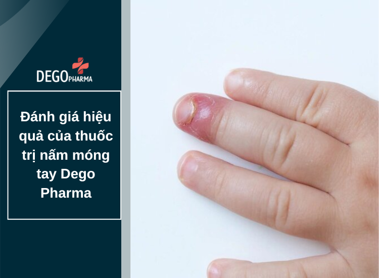 ​​​​​​​Đánh giá hiệu quả của thuốc trị nấm móng tay Dego Pharma