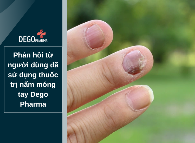 Phản hồi từ người dùng đã sử dụng thuốc trị nấm móng tay Dego Pharma