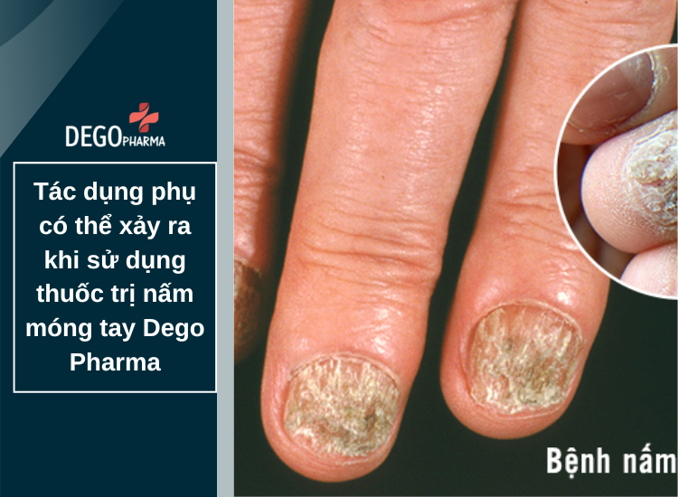 Tác dụng phụ có thể xảy ra khi sử dụng thuốc trị nấm móng tay Dego Pharma