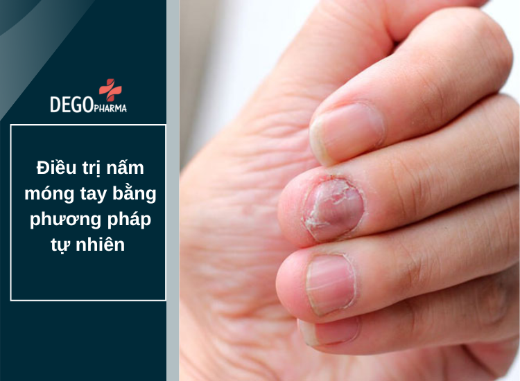 Bạn đã biết cách điều trị nấm móng tay bằng phương pháp tự nhiên chưa?