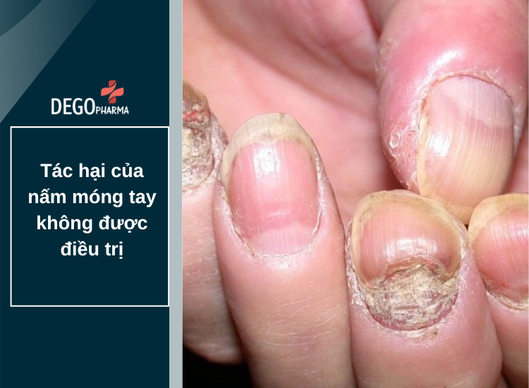 ​​​​​​​Tìm hiểu về tác hại của nấm móng tay không được điều trị kịp thời