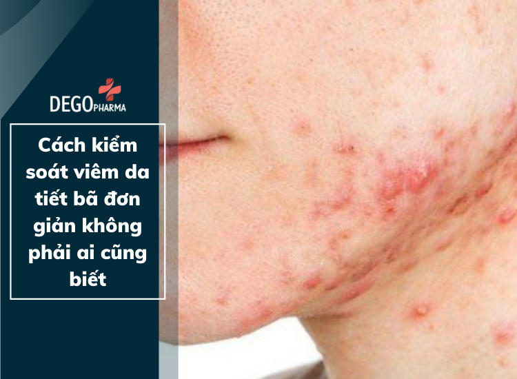 Cách kiểm soát viêm da tiết bã đơn giản không phải ai cũng biết