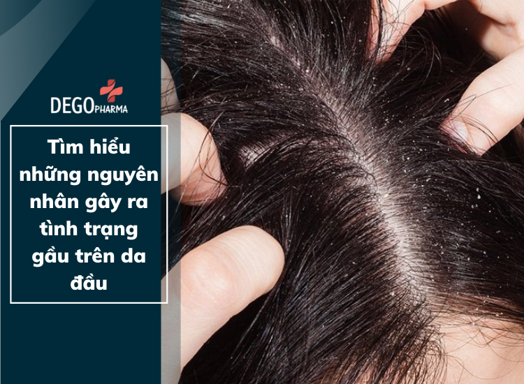 Tìm hiểu những nguyên nhân gây ra tình trạng gầu trên da đầu