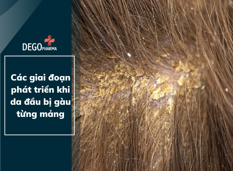 Các giai đoạn phát triển khi da đầu bị gàu từng mảng