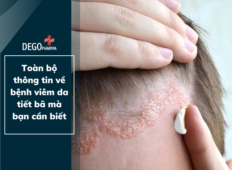 Viêm da tiết bã: Toàn bộ thông tin về bệnh mà bạn cần biết