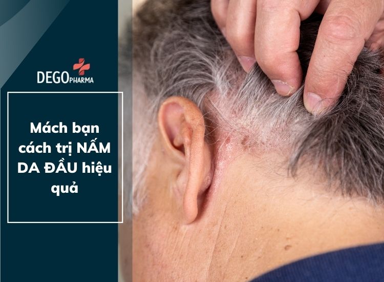 Mách bạn cách trị nấm da đầu hiệu quả