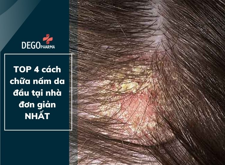 TOP 4 cách chữa nấm da đầu tại nhà đơn giản NHẤT