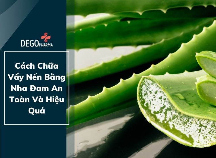 Cách Chữa Vẩy Nến Bằng Nha Đam An Toàn Và Hiệu Quả