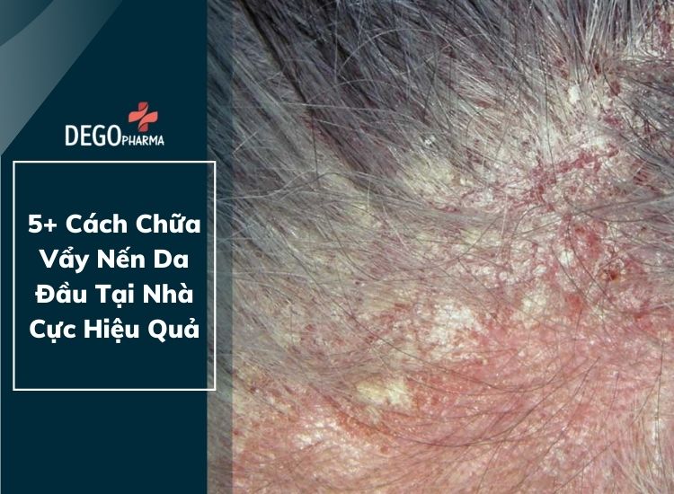 5+ Cách Chữa Vẩy Nến Da Đầu Tại Nhà Cực Hiệu Quả