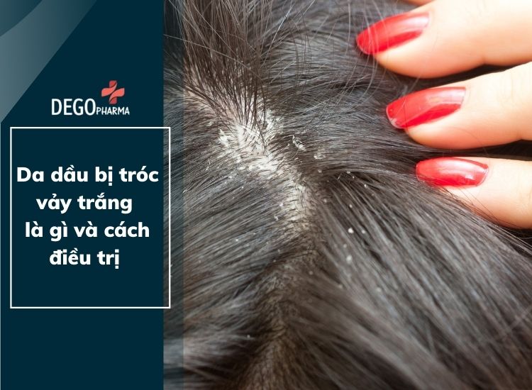 Da dầu bị tróc vảy trắng là gì và cách điều trị an toàn, hiệu quả