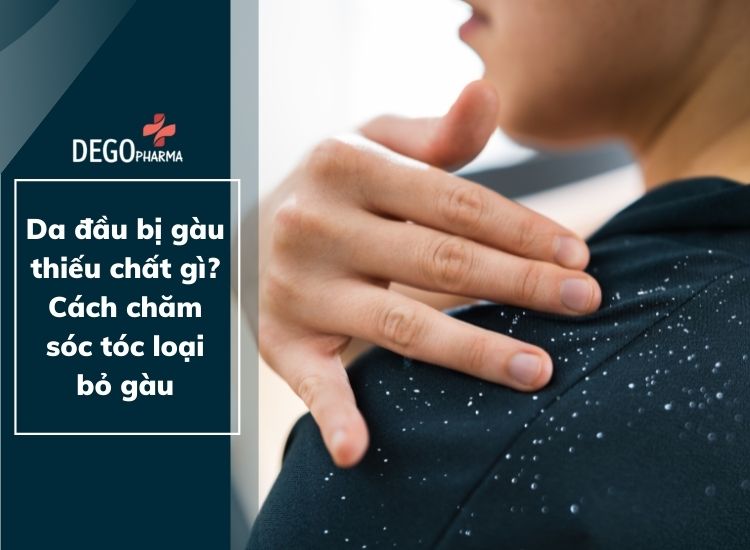 Da đầu bị gàu thiếu chất gì? Cách chăm sóc tóc loại bỏ gầu