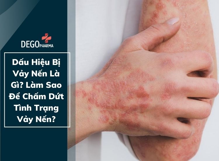 Dấu Hiệu Bị Vảy Nến Là Gì? Làm Sao Để Chấm Dứt Tình Trạng Vảy Nến?