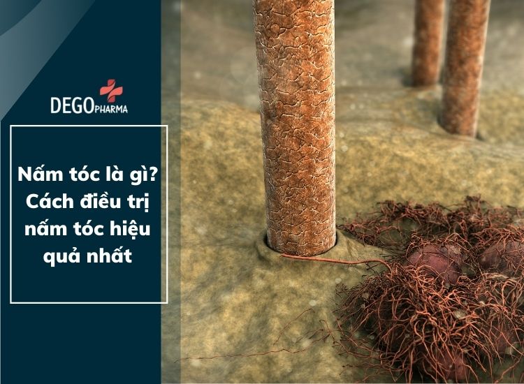 Nấm tóc là gì? Cách điều trị nấm tóc hiệu quả nhất