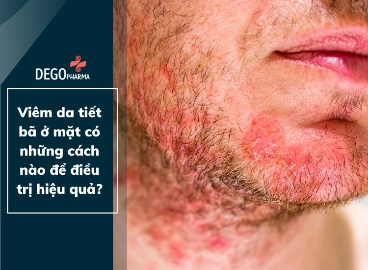 Viêm da tiết bã ở mặt có những cách nào để điều trị hiệu quả?