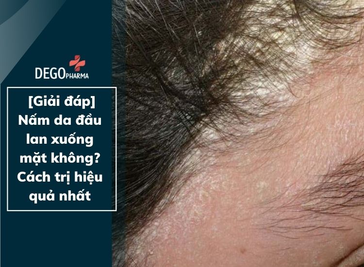 [Giải đáp] Nấm da đầu lan xuống mặt không? Cách trị hiệu quả nhất