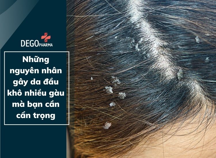 Những nguyên nhân gây da đầu khô nhiều gàu mà bạn cần cẩn trọng